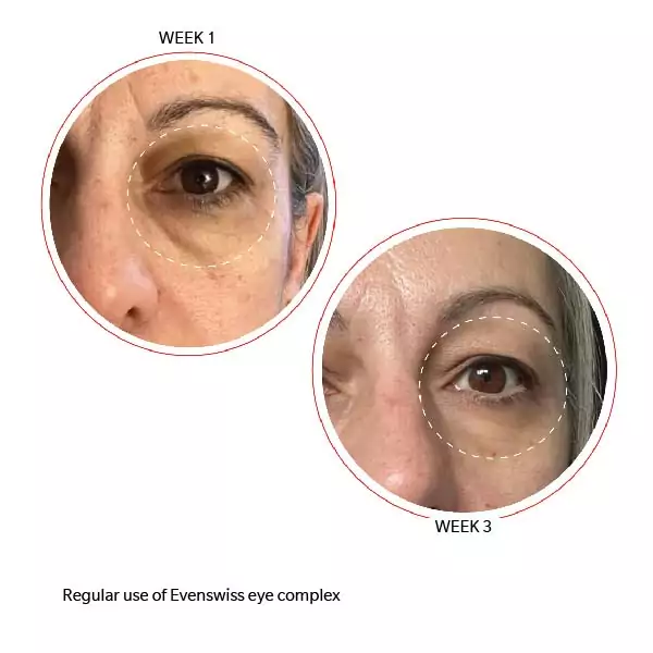 Evenswiss Eye Complex and Rich Cream Bundle before and after