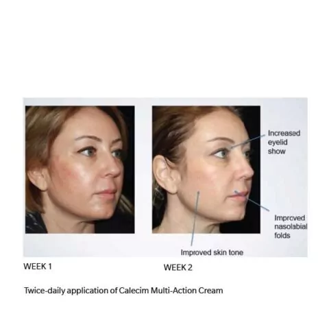 Calecim Multi-Action Cream 50g before and after
