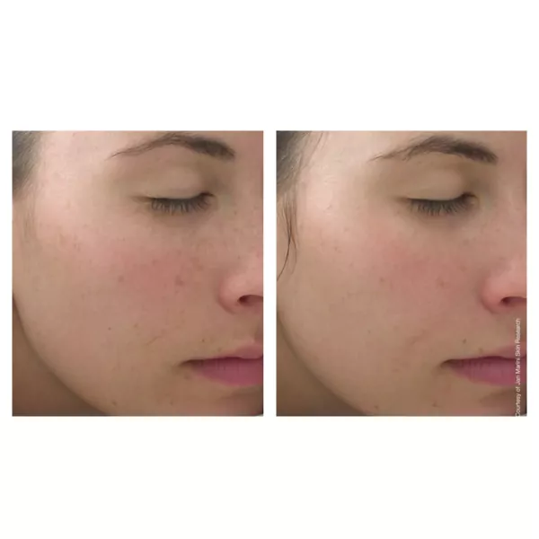 Jan Marini C-esta face serum before after