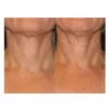 Neostrata Triple Firming Neck Cream Before and After
