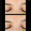 Image showing visible improvements of fine lines and density at the forehead after using allies of skin retinal and peptides repair night cream for 28 days