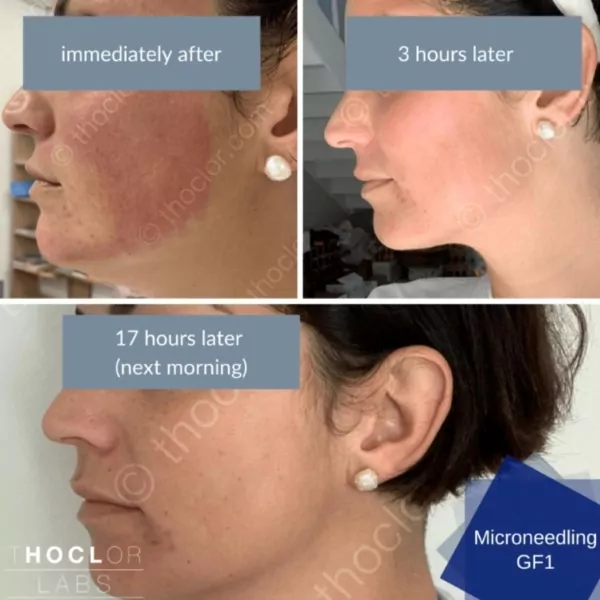 thoclor gf1 aftercare before and after