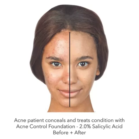 Oxygenetix Acne Control Foundation before and after