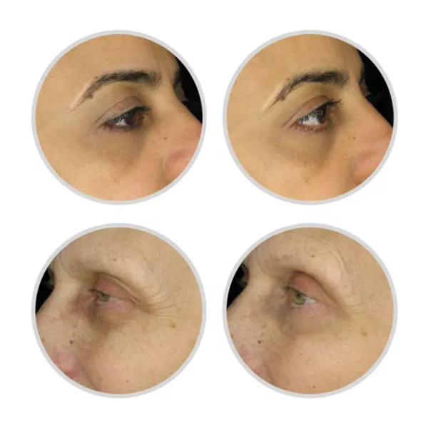 before and after dark circles, crow