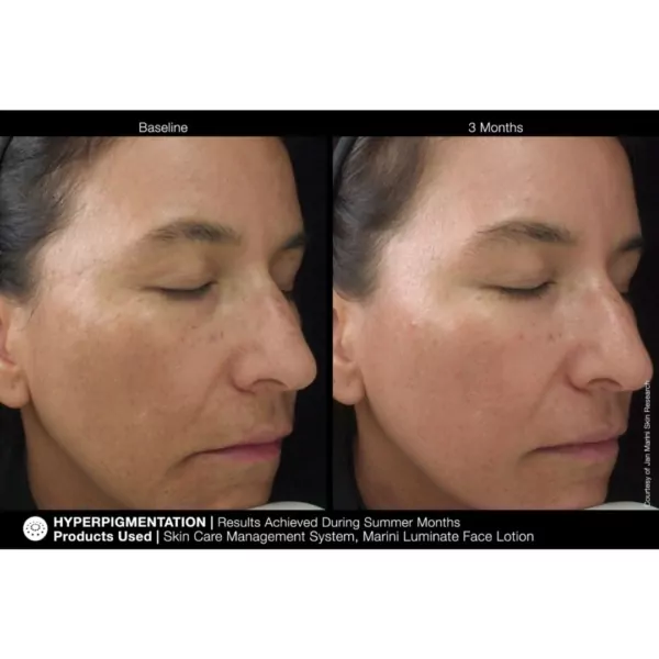 Jan Marini Luminate Face Lotion MD before and after