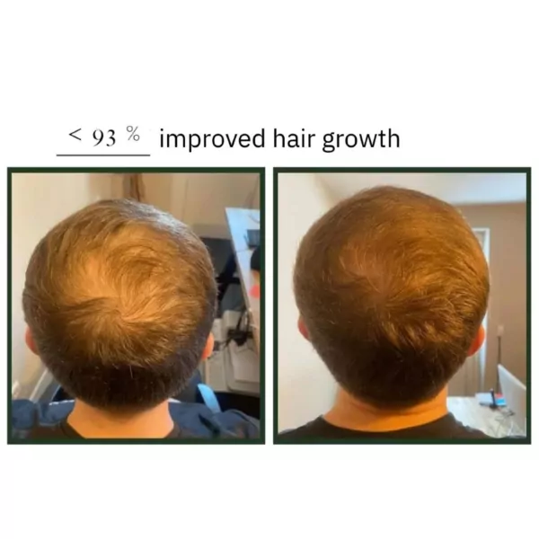 natucain hair activator growth serum results before and after