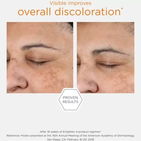 NeoStrata Enlighten Illuminating Serum before and after