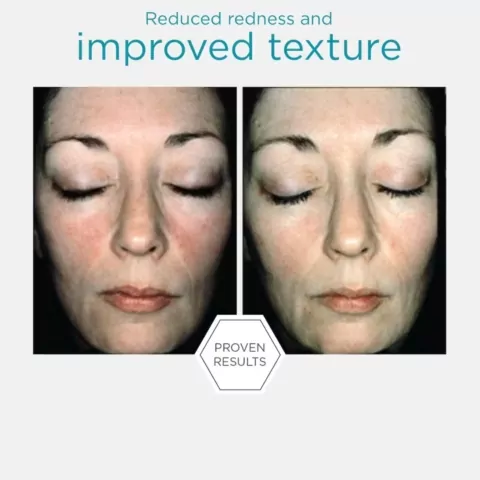 NeoStrata Restore Bionic Face Cream before and after
