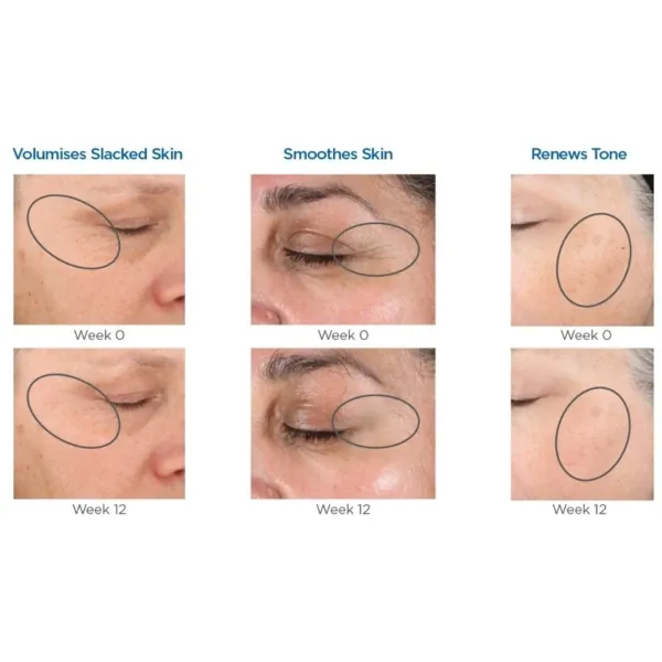NeoStrata Tri Therapy Lifting Serum before and after