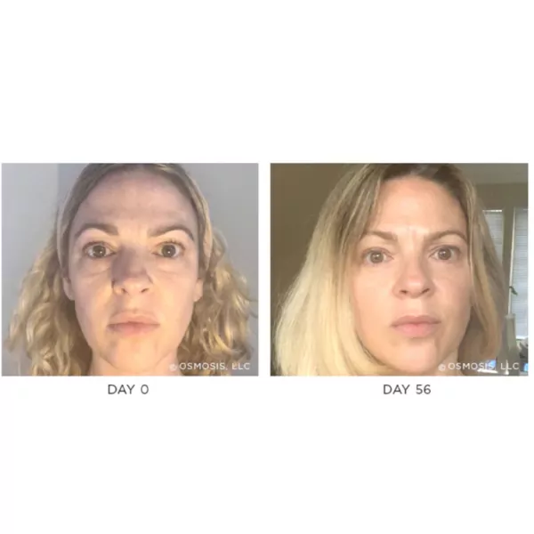 Osmosis Recovery before After 2