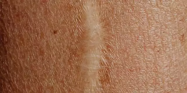 the best stretch marks cream