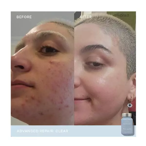 vida glow clear before and after